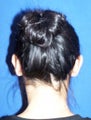 Ear Surgery (otoplasty)