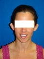 Ear Surgery (otoplasty)