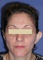 Ear Surgery (Otoplasty)