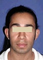 Otoplasty (Ear Surgery)