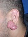 Ear Surgery