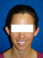 Otoplasty (Ear Surgery)
