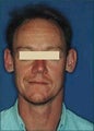 Otoplasty (Ear Surgery)