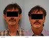 Otoplasty
