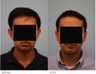 Otoplasty