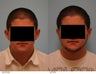 Otoplasty