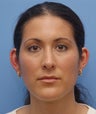 Otoplasty