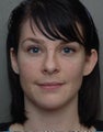 Otoplasty