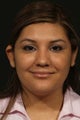 Otoplasty