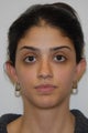 Otoplasty (Ear Surgery)