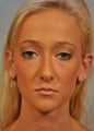 Corrective Ear Surgery