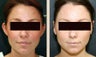 Otoplasty