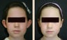 Otoplasty