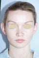Otoplasty