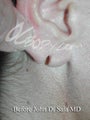 Ear Repair - Earlobe