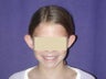 Otoplasty