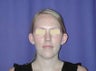 Otoplasty (ear surgery)