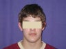 Otoplasty
