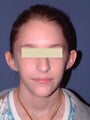 Otoplasty (correction of outstanding ears)