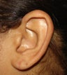 Torn earlobe Repair