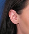 Earlobe Gauge Repair