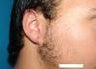 Repair of split earlobe