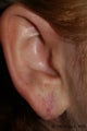 Earlobe Repair