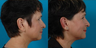 Earlobe Reduction