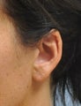 Ear Lobe Repair