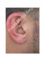 Earlobe Repair Surgery
