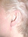 Earlobe Repair Surgery