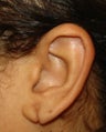 Torn earlobe Repair