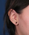 Earlobe Gauge Repair