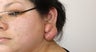 Ear lobe Keloid