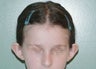 otoplasty/ear set back