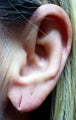 Earlobe Repair