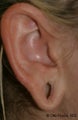 Earlobe Repair