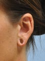 Ear Lobe Repair