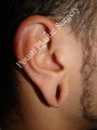 Earlobe Repair Surgery
