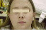 Ear Surgery (Otoplasty)