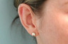 Ear Surgery (Otoplasty)
