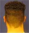Otoplasty