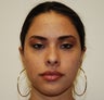 Otoplasty