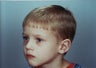 Otoplasty