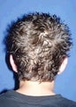 Ear Surgery (Otoplasty)