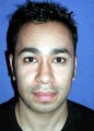 Ear Surgery (Otoplasty)