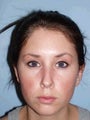 Ear Surgery (Otoplasty)