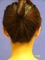 Ear Surgery (Otoplasty)