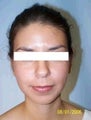 Ear Surgery (Otoplasty)