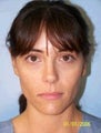 Ear Surgery (Otoplasty)